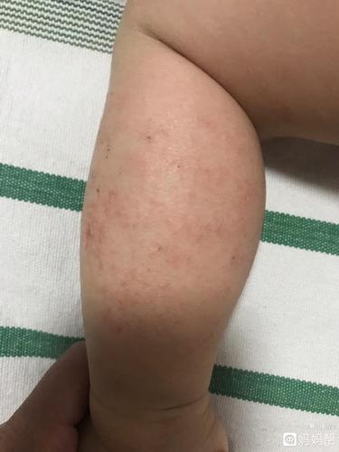 第三代助孕宝宝湿疹了能吃什么